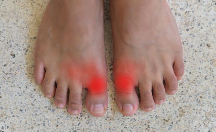Sakit di ibu jari kaki dengan gout
